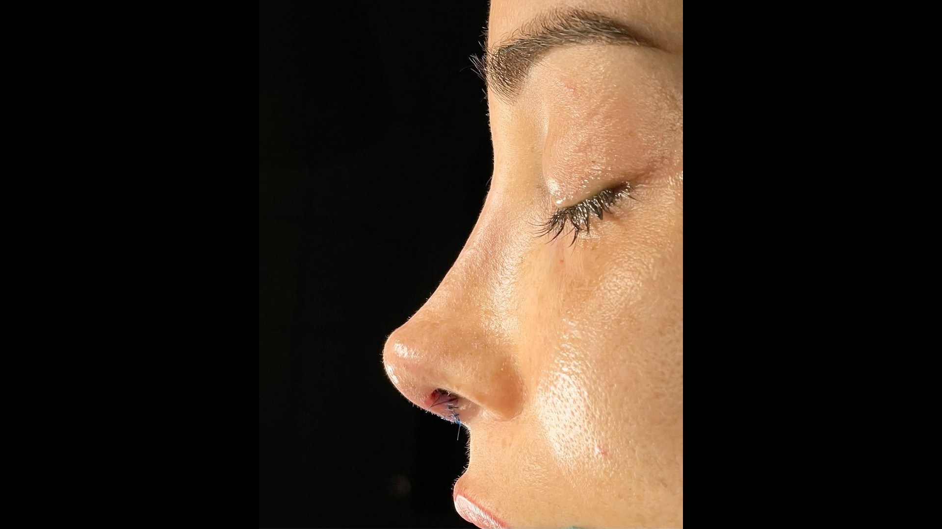 Rinoplastia natural — Rhino & Face